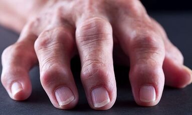 Quelle est la différence entre l'arthrite due à l'arthrose