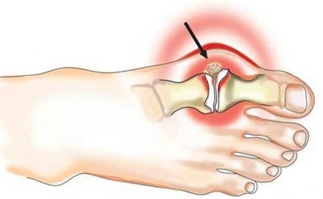 Inflammation de l'articulation entre le gros orteil et le pied due à l'arthrite