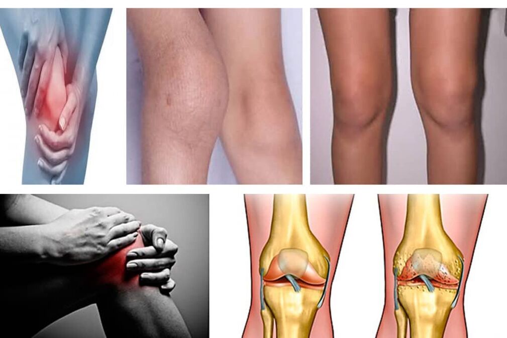 L'arthrose, qu'est-ce que c'est 