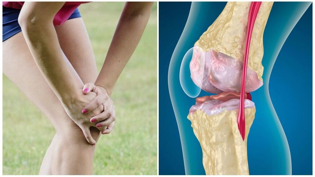 Symptômes de l'arthrose